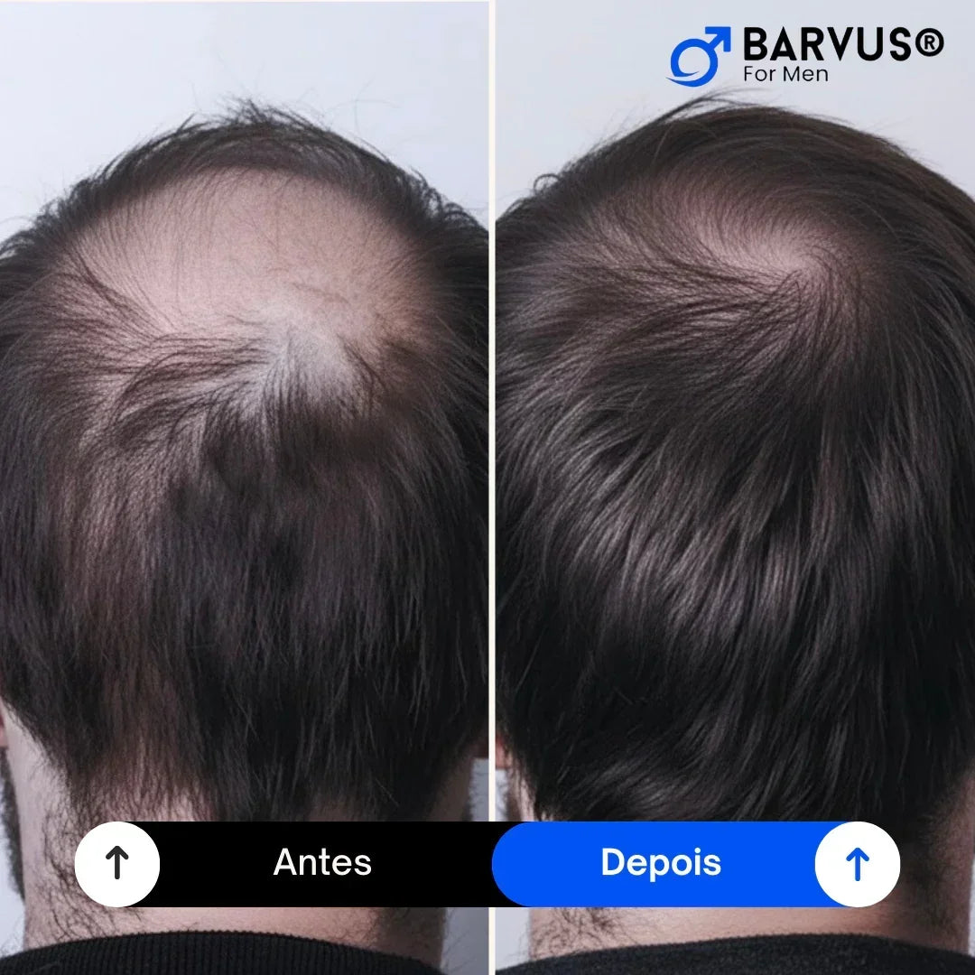 Minoxidil KIRKLAND® 5% - Original